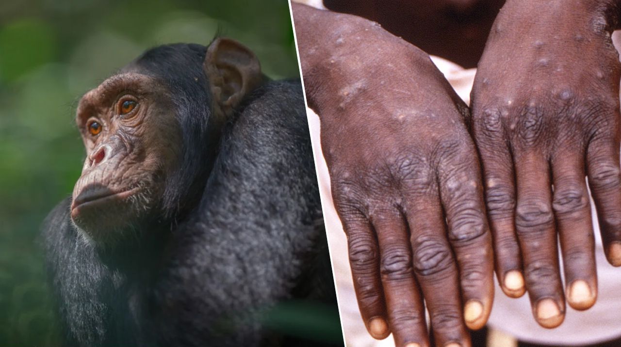 A new epidemic of monkeypox has broken out in the world